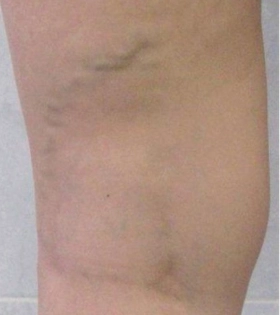 Склеротерапия - фото до