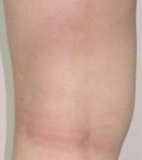 Склеротерапия - фото після