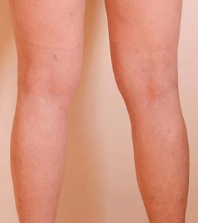 Склеротерапия - фото після