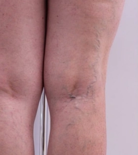 Минифлебэктомия - фото до