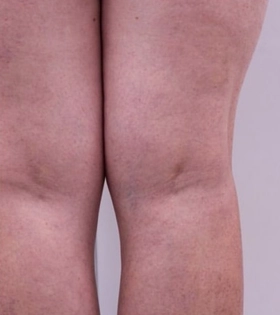 Минифлебэктомия - фото після