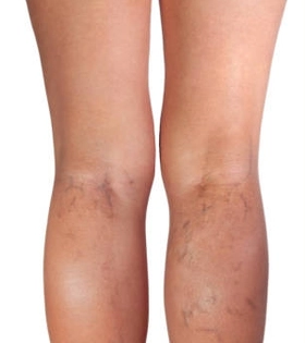 Минифлебэктомия - фото до