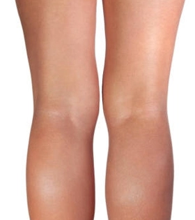 Минифлебэктомия - фото після