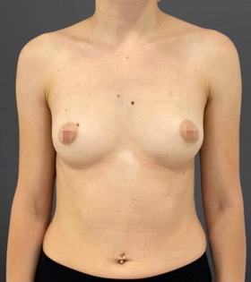 Увеличение груди, круглые импланты MENTOR - фото до