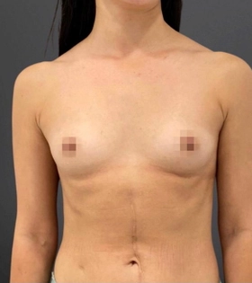 Увеличение груди, круглые импланты MENTOR - фото до