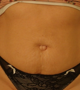 Удаленіе пупочной грижі - фото до