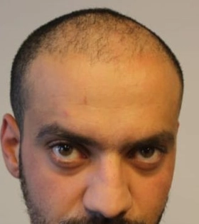 Пересадка волос 2100 графт - фото до