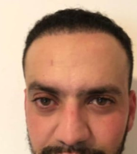 Пересадка волос 2100 графт - фото після