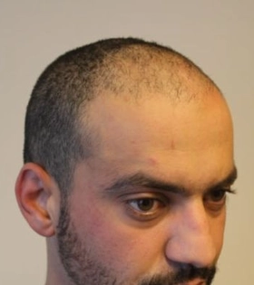 Пересадка волос 2100 графт - фото до