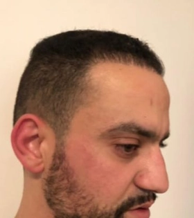 Пересадка волос 2100 графт - фото після