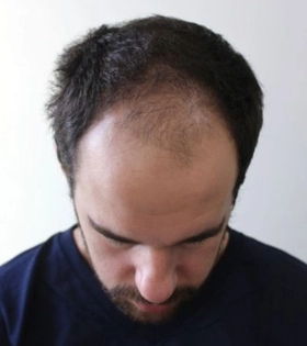 Пересадка волос 2000 графт - фото до