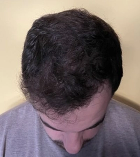 Пересадка волос 2000 графт - фото після