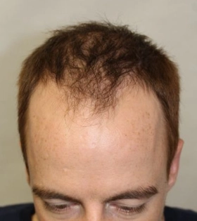 Пересадка волос 2000 графт - фото до