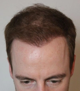 Пересадка волос 2000 графт - фото після