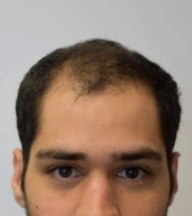 Пересадка волос 1800 графт - фото до