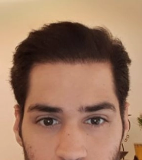 Пересадка волос 1800 графт - фото після