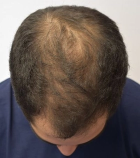 Пересадка волос 1800 графт - фото до