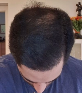 Пересадка волос 1800 графт - фото після