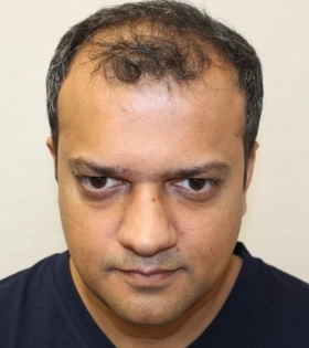 Пересадка волос 2500 графт - фото до