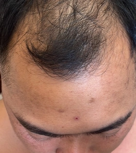 Пересадка волос 2500 графт - фото після