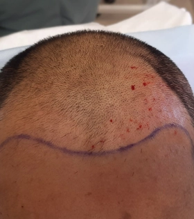 Пересадка волос 2500 графт - фото до