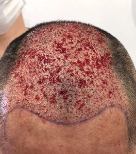 Пересадка волос 2500 графт - фото після