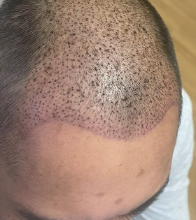 Пересадка волос 2500 графт - фото до