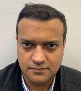 Пересадка волос 2500 графт - фото після