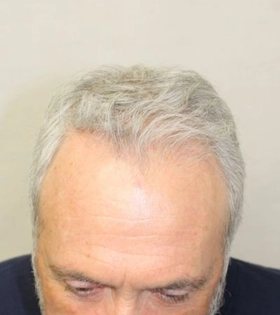 Пересадка волос 2500 графт - фото до