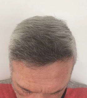 Пересадка волос 2500 графт - фото після