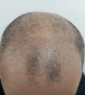 Пересадка волос 2800 графт - фото до