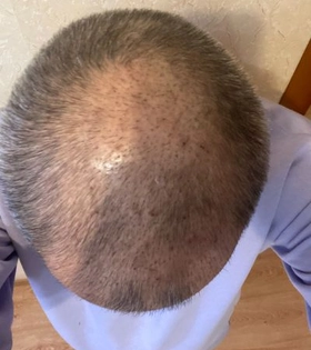 Пересадка волос 2800 графт - фото після