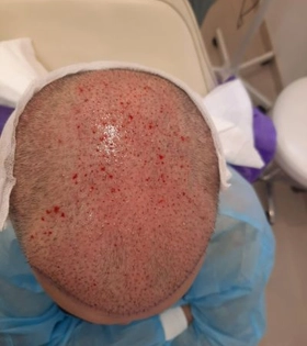 Пересадка волос 2800 графт - фото після