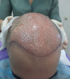 Пересадка волос 2800 графт - фото до