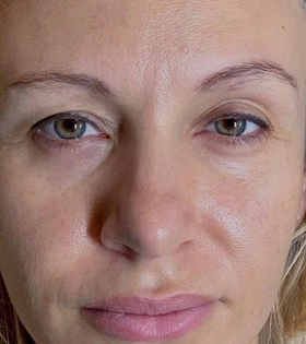 Плазмотерапия (Плазмолифтинг) - фото до