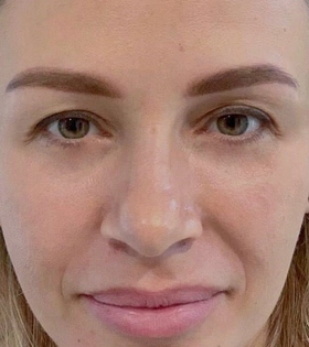 Плазмотерапия (Плазмолифтинг) - фото після