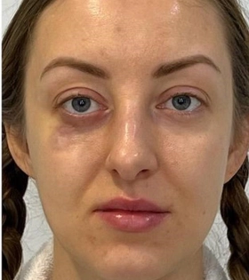 Пластика горбинки носа - фото до