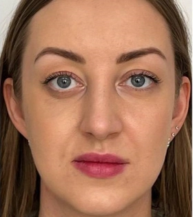 Пластика горбинки носа - фото після