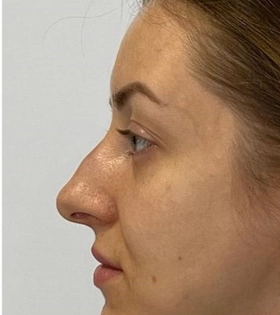Пластика горбинки носа - фото до