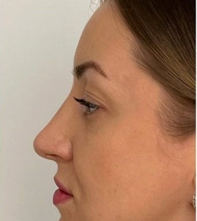 Пластика горбинки носа - фото після