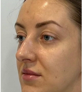 Пластика горбинки носа - фото до