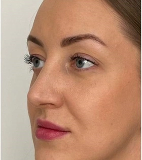 Пластика горбинки носа - фото після