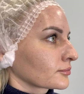 Биоревитализация - фото після