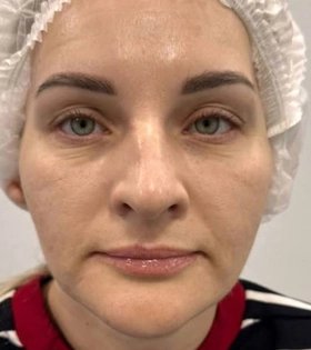 Биоревитализация - фото до