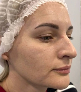 Биоревитализация - фото після