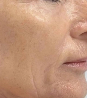 Биоревитализация - фото після