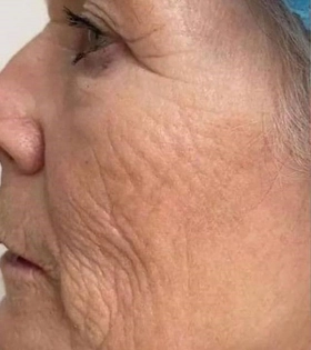 Биоревитализация - фото до