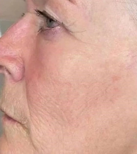 Биоревитализация - фото після