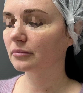 Микроигольчатый рф лифтинг - фото до