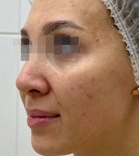 Микроигольчатый рф лифтинг - фото до